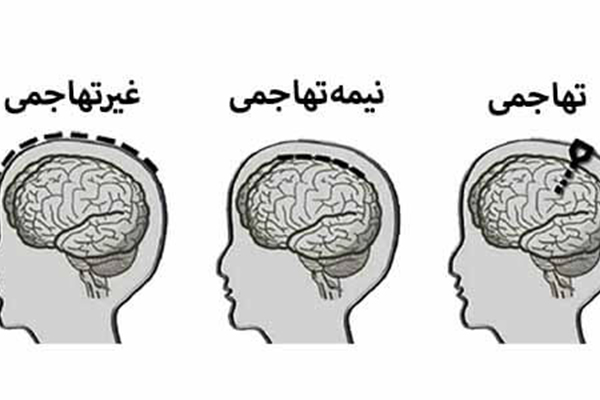 انواع واسط مغز کامپیوتر (BCI)